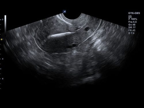 Dispositivo intra-uterino (DIU) no modo 2D