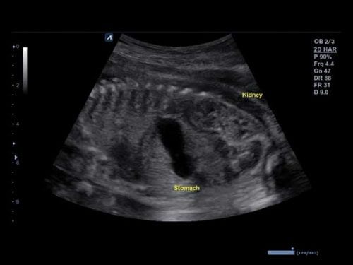 Excelente imagem 2D de um feto de 22 semanas com boa resolução de contraste